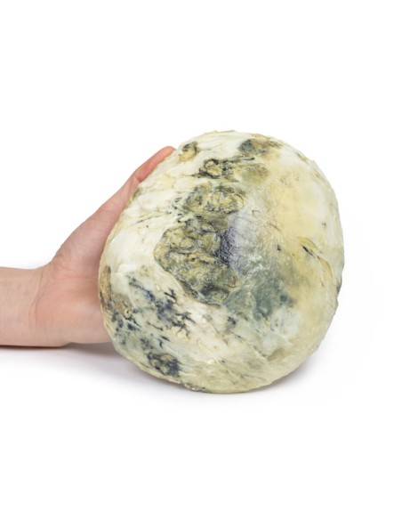 Syphilis tertiaire - Erler Zimmer 3D anatomy Series MP2113