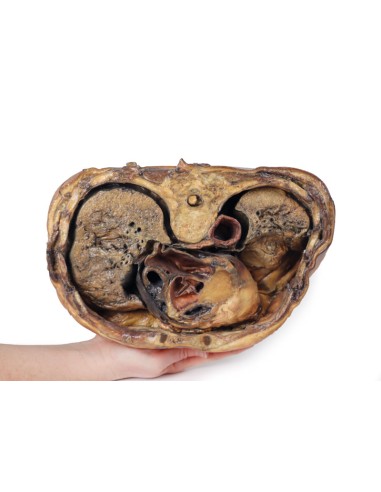 Sezione del torace sulla vertebra T6 - Erler...