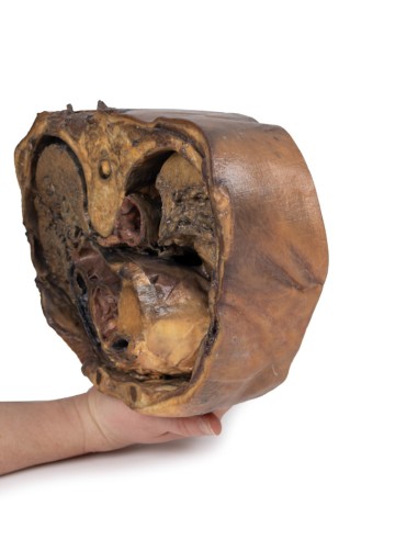 Sezione del torace sulla vertebra T6 - Erler...