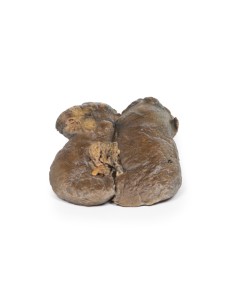 Renal cell carcinoma - Erler Zimmer 3D anatomy Series MP2097 2