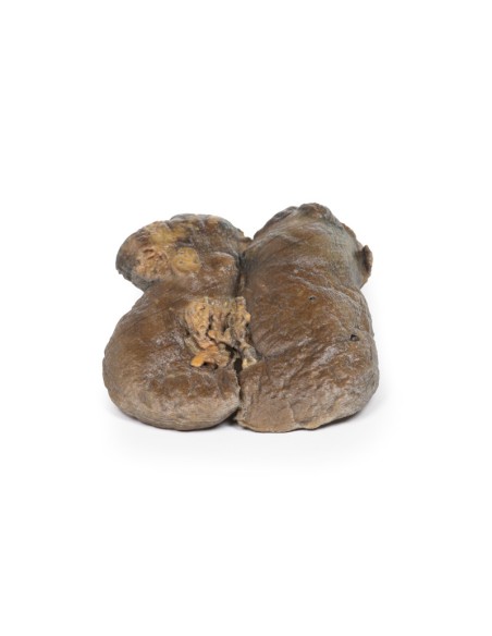 Renal cell carcinoma - Erler Zimmer 3D anatomy Series MP2097