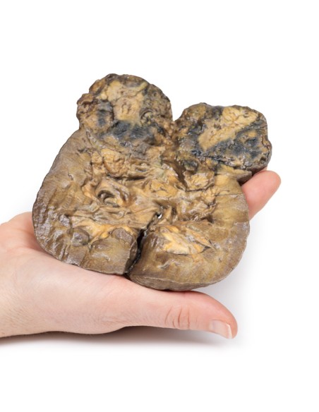 Renal cell carcinoma - Erler Zimmer 3D anatomy Series MP2097