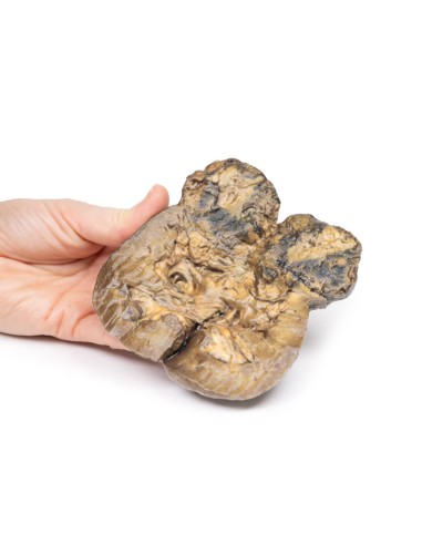 Carcinoma de células renales - Erler Zimmer 3D...