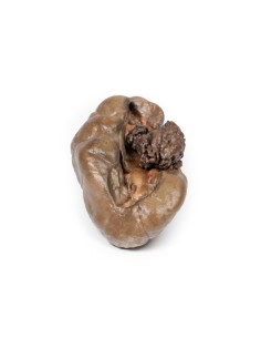 Transitional cell papillary carcinoma of the renal pelvis...