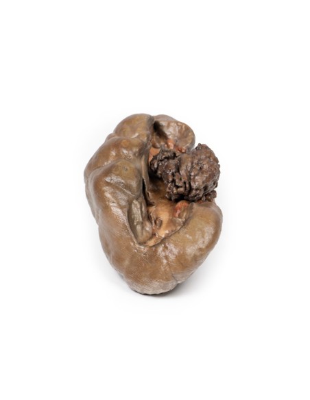 Transitional cell papillary carcinoma of the renal pelvis - Erler Zimmer 3D anatomy Series MP2099