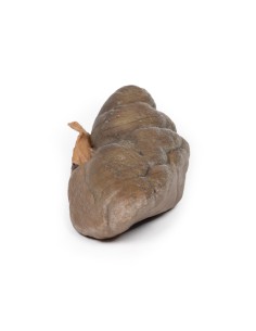 Carcinoma papillare a cellule di transizione della pelvi... 2
