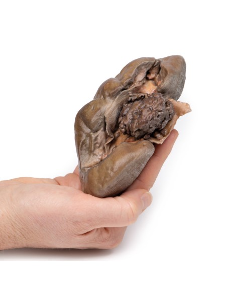 Carcinome papillaire transitionnel du bassinet du rein - Erler Zimmer 3D anatomy Series MP2099