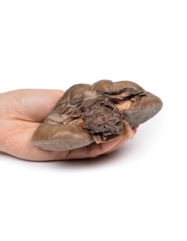 Transitional cell papillary carcinoma of the...