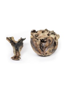 Hydatid disease affecting the heart and aorta - Erler...