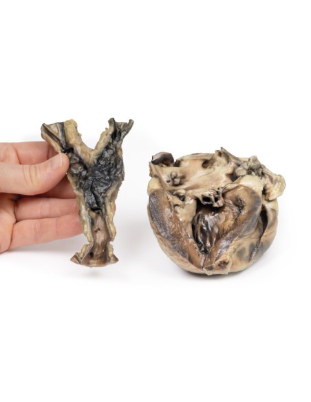 Malattia idatidea che colpisce il cuore e l'aorta - Erler Zimmer 3D anatomy Series MP2035