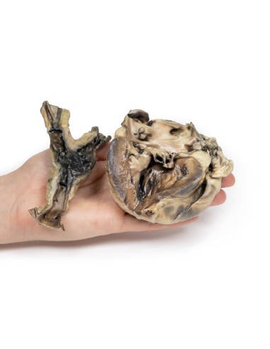 Maladie hydatique affectant le cœur et l'aorte...