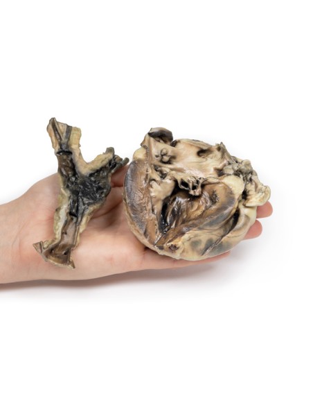 Hydatid disease affecting the heart and aorta - Erler Zimmer 3D anatomy Series MP2035