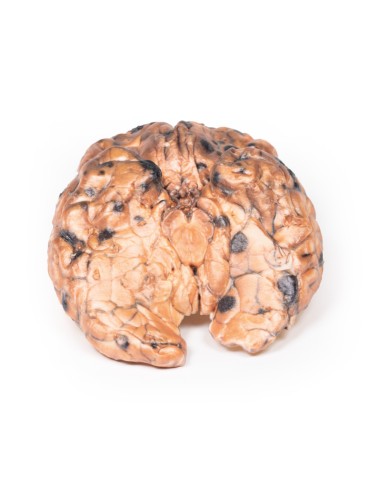 Melanoma metastásico - Erler Zimmer 3D anatomy...