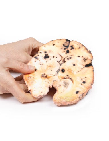 Melanoma metastásico - Erler Zimmer 3D anatomy...