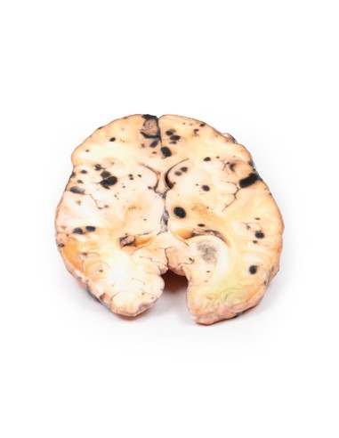 Metastasiertes Melanom - Erler Zimmer...