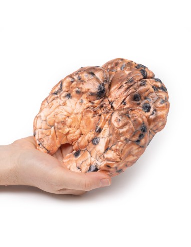 Melanoma metastatico - Erler Zimmer 3D anatomy...