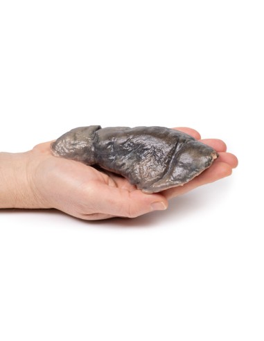 Polmone: fibrosi cistica - Erler Zimmer 3D...