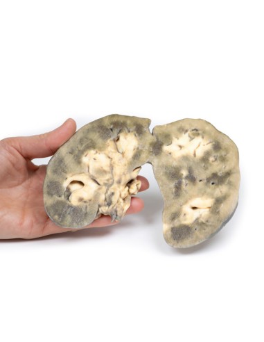 Horseshoe kidney - Erler Zimmer 3D anatomy...