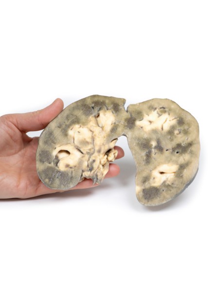 Horseshoe kidney - Erler Zimmer 3D anatomy Series MP2092