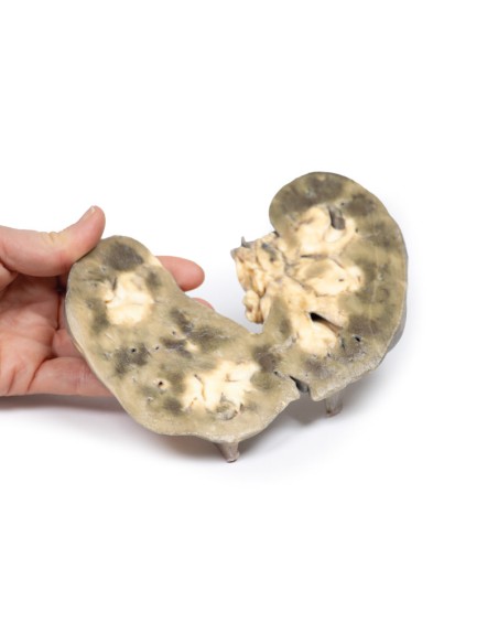 Horseshoe kidney - Erler Zimmer 3D anatomy Series MP2092