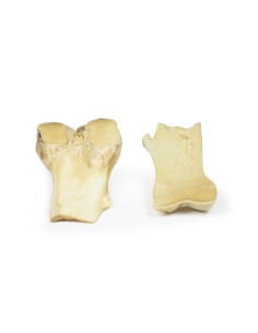 Osteochondroma - Erler Zimmer 3D anatomy Series MP2118