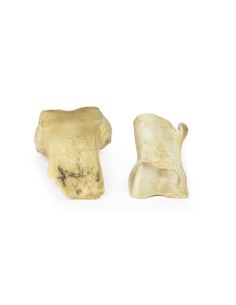 Osteochondroma - Erler Zimmer 3D anatomy Series MP2118 2