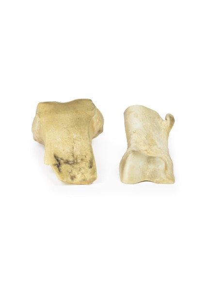 Osteochondrom - Erler Zimmer 3D Anatomie Serie MP2118