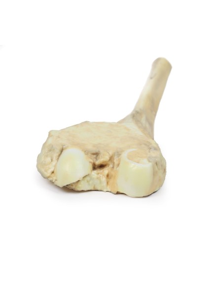 Osteosarcoma de fémur - Erler Zimmer 3D anatomy Series MP2115