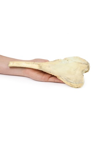 Ostéosarcome du fémur - Erler Zimmer 3D anatomy...