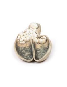 Cholecystitis and cholelithiasis - Erler Zimmer 3D...