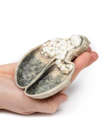 Colecistitis y colelitiasis - Erler Zimmer 3D...