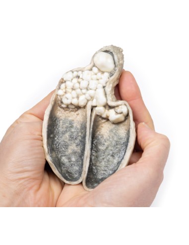 Colecistitis y colelitiasis - Erler Zimmer 3D...