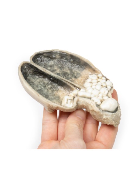 Colecistitis y colelitiasis - Erler Zimmer 3D anatomy Series MP2082