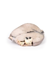 Hepatic duct calculi and obstructive biliary cirrhosis -...