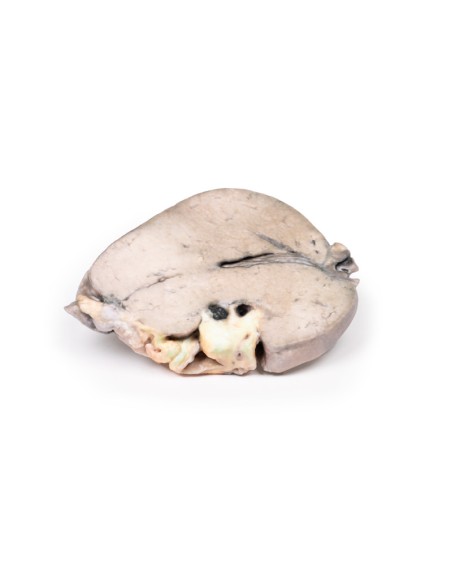 Calcoli del dotto epatico e cirrosi biliare ostruttiva - Erler Zimmer 3D anatomy Series MP2084