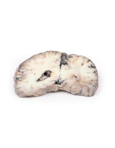 Cerebral Arterio-Venous Malformation - Erler Zimmer 3D... 2