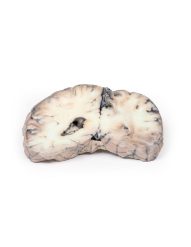 Malformazione Arterio-Venosa Cerebrale - Erler...