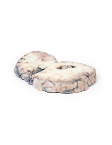 Malformación arteriovenosa cerebral - Erler...