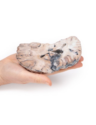 Malformazione Arterio-Venosa Cerebrale - Erler...