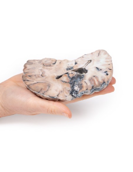 Malformation artério-veineuse cérébrale - Erler Zimmer 3D anatomy Series MP2010