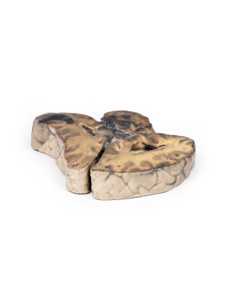 Intracranial injury - Erler Zimmer 3D anatomy Series MP2011