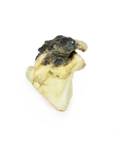 Condrosarcoma della scapola - Erler Zimmer 3D anatomy...