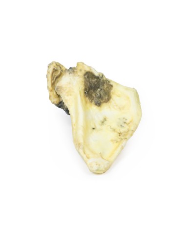 Chondrosarcoma of the scapula - Erler Zimmer 3D...