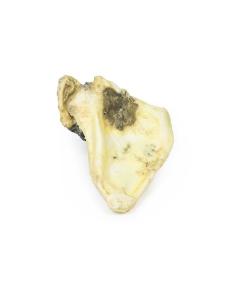 Chondrosarcoma of the scapula - Erler Zimmer 3D anatomy Series MP2114