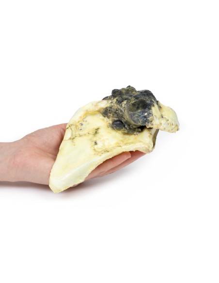 Condrosarcoma della scapola - Erler Zimmer 3D anatomy Series MP2114