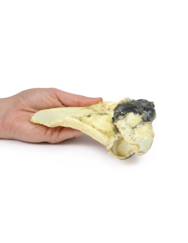 Chondrosarcome de l'omoplate - Erler Zimmer 3D...