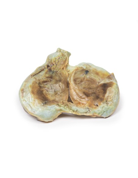 Idrocele cronico - Erler Zimmer 3D anatomy Series MP2110