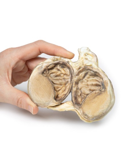 Idrocele cronico - Erler Zimmer 3D anatomy Series MP2110