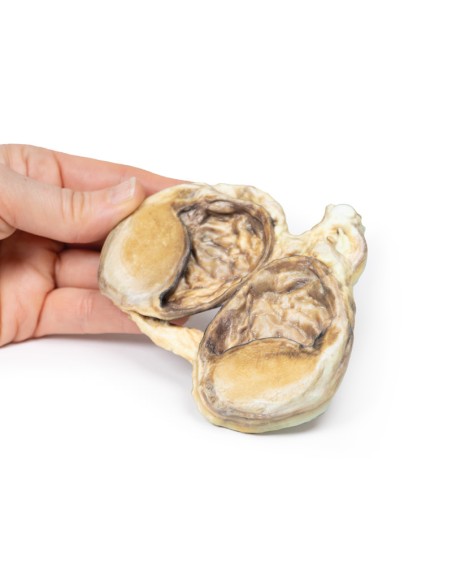 Idrocele cronico - Erler Zimmer 3D anatomy Series MP2110