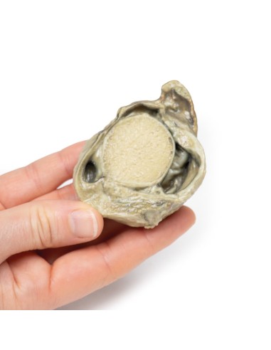 Hydrocele - Erler Zimmer 3D anatomy Series MP2109